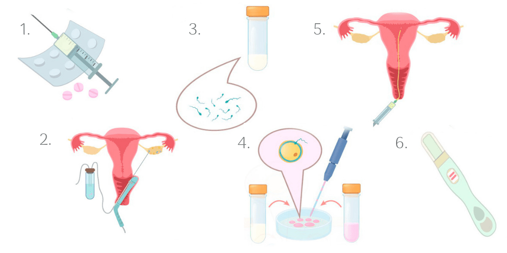 Understanding the stages of IVF